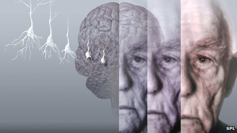 Alzheimer's breakthrough: Cure or hype?